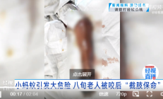 
        		老人手被被蚂蚁咬一口 没在意竟需截肢保命 医生：咬伤后 警惕“危险信号” !	