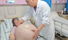 河北一女子肚子长80斤罕见巨瘤:血管暴突如蛛网 4小时切下